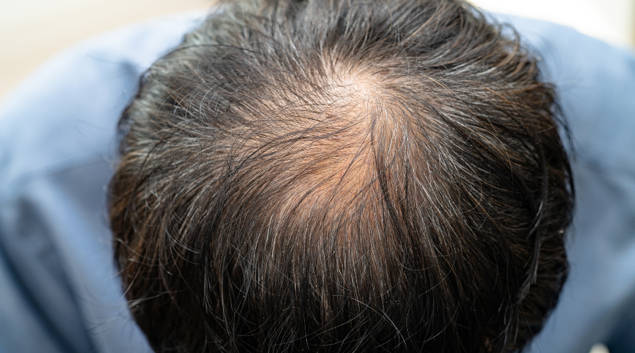 Hair Loss & Baldness Treatment